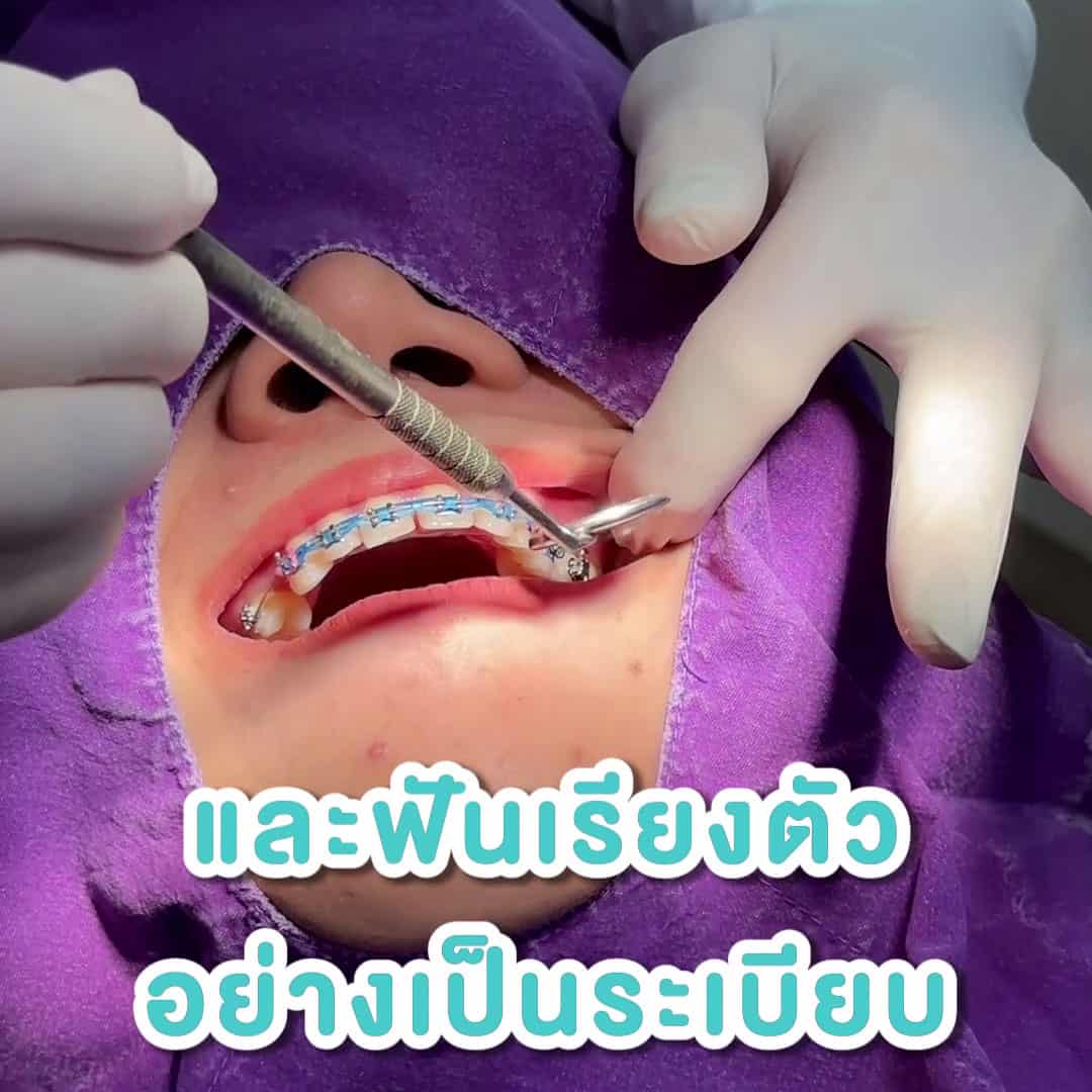 จัดฟัน ฟันชิดสวยงาม