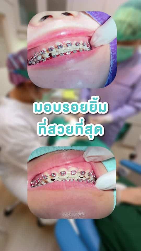 จัดฟัน ปก มอบรอยยิ้มที่สวยที่สุด Resize