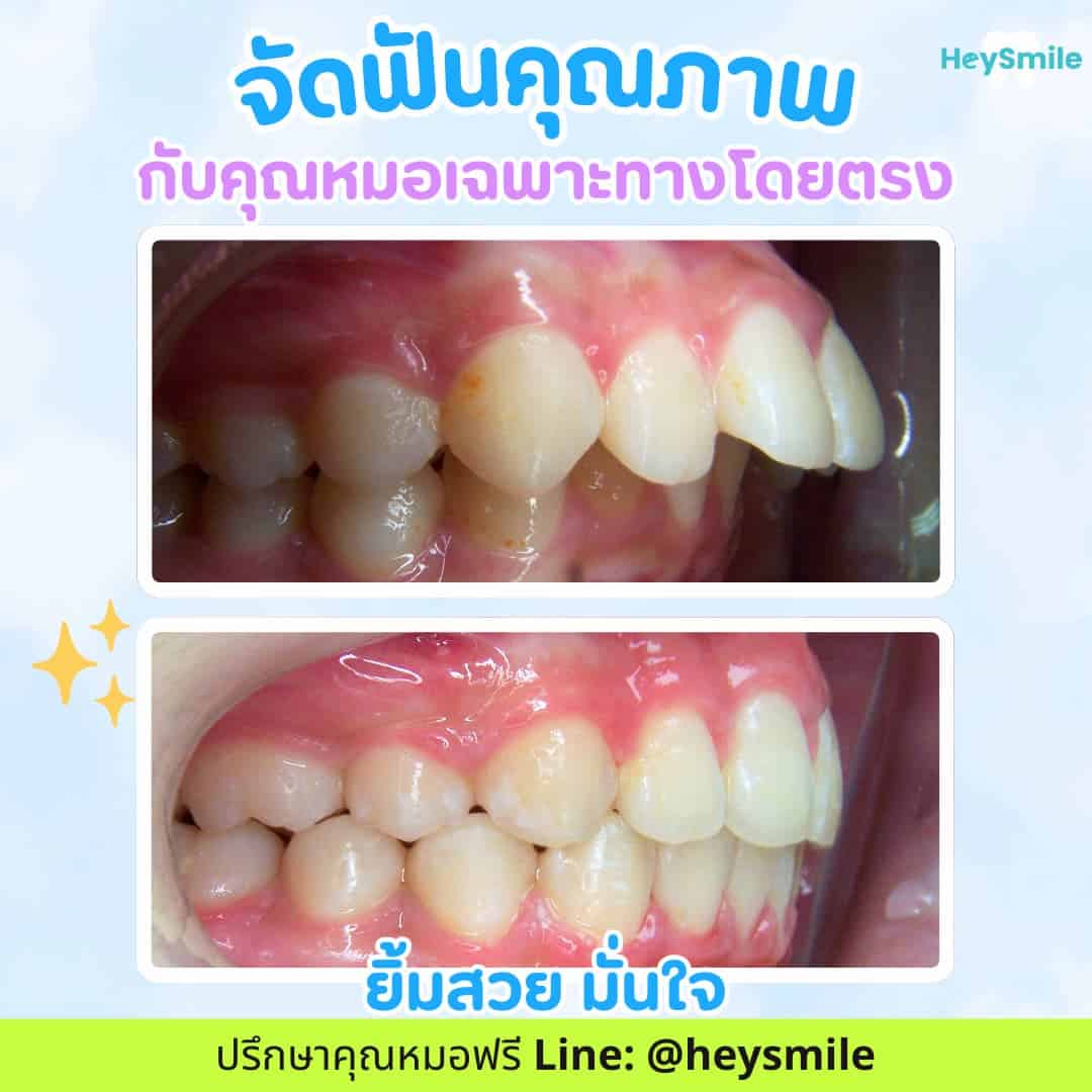จัดฟันฟันยื่น รีวิว จัดฟัน