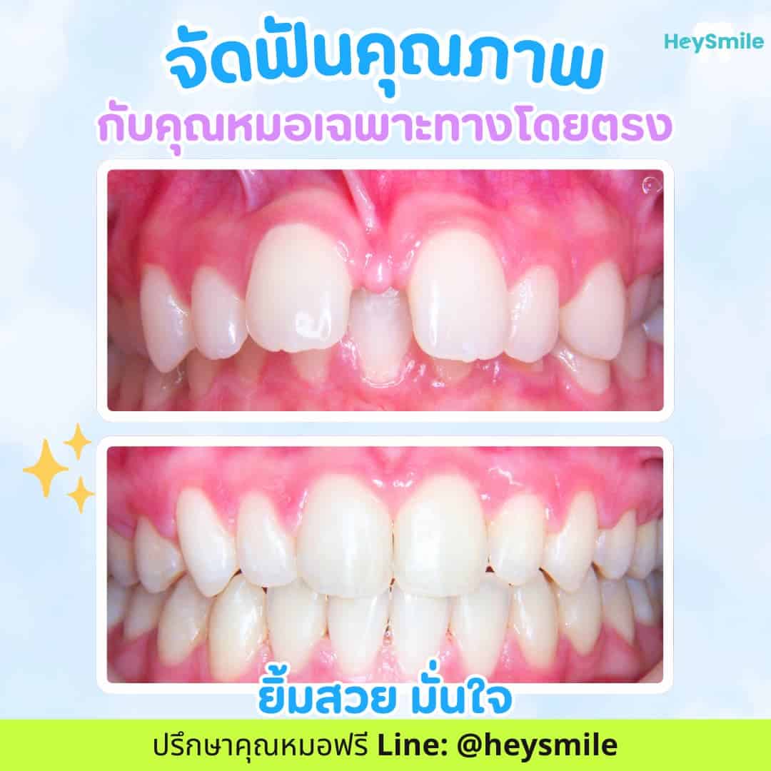 จัดฟัน ฟันห่าง รีวิว จัดฟัน