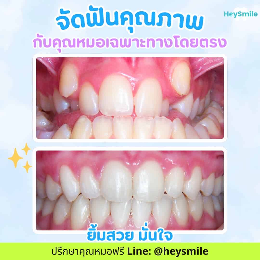 รีวิว จัดฟัน 3