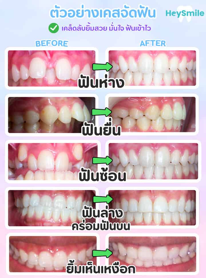 จัดฟัน ฟันห่าง รวมเคส