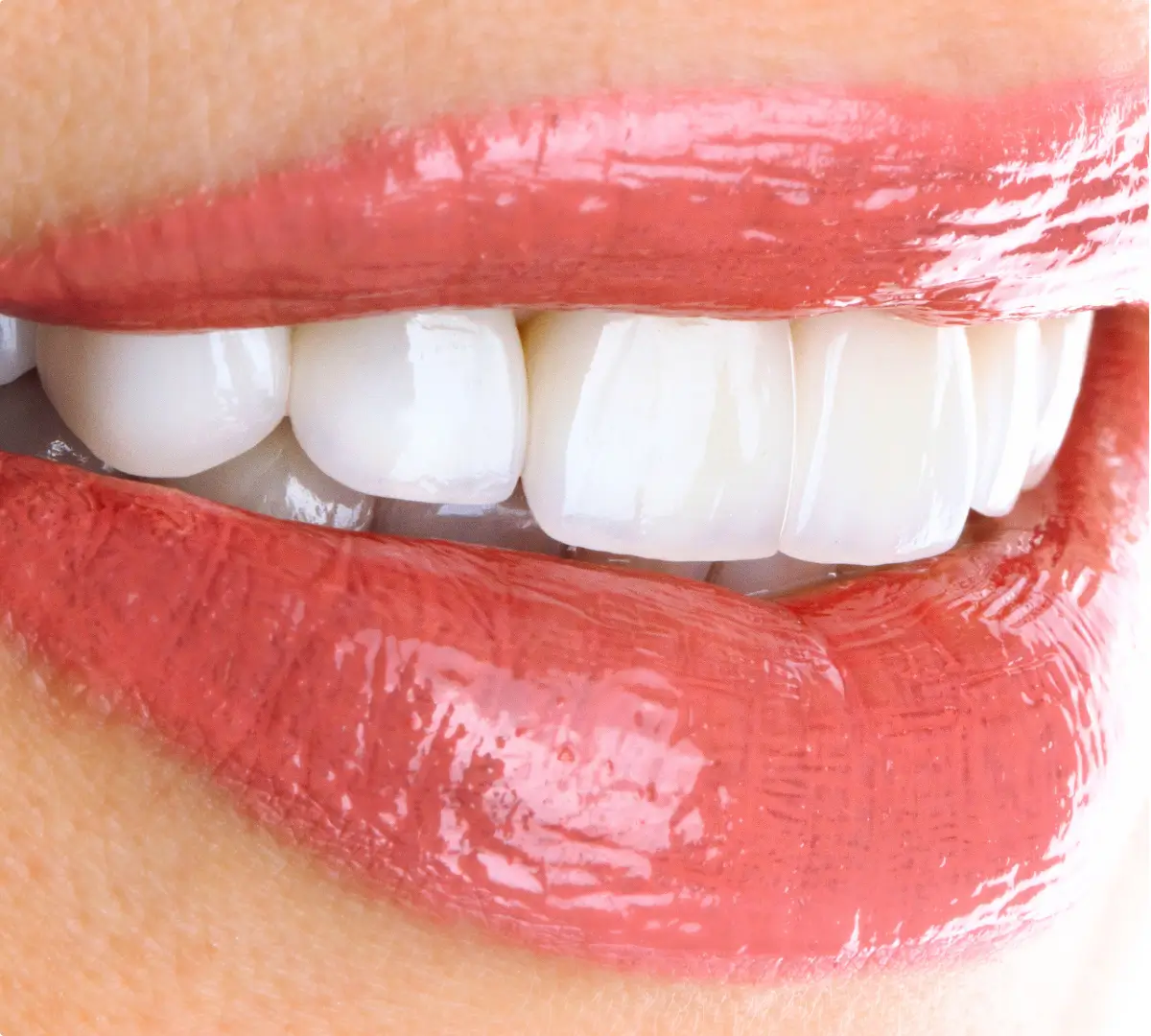 Dental services Veneer