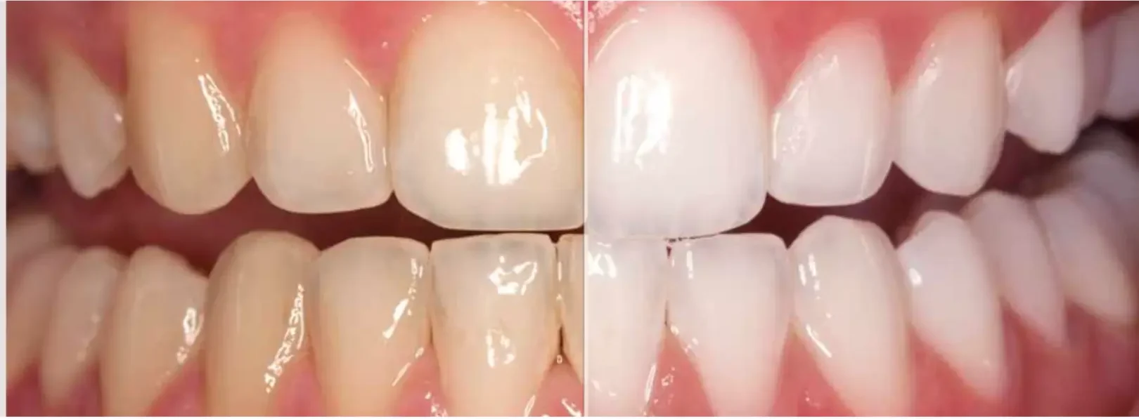 Teeth Whitening1 e1742917116413