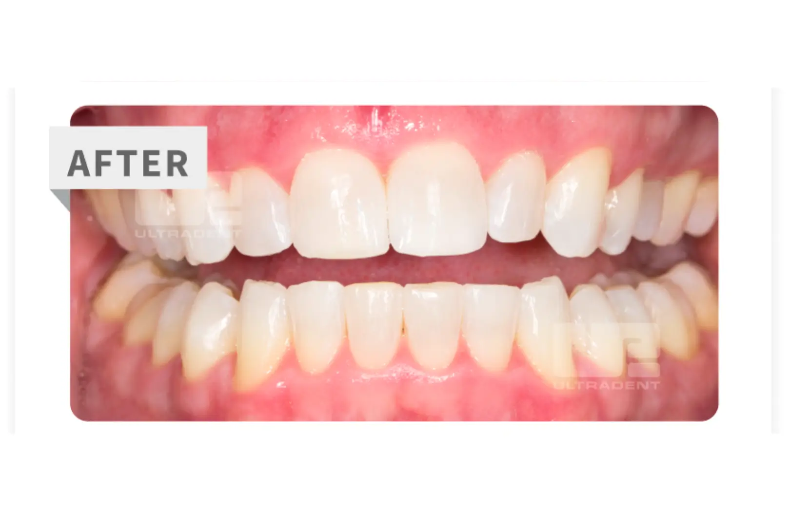 Teeth Whitening3
