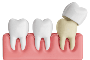 ครอบฟัน หลังจากรักษารากฟัน จำเป็นไหม