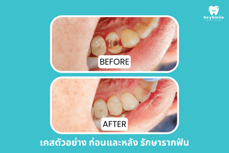 ภาพ ก่อนและหลัง รักษารากฟัน