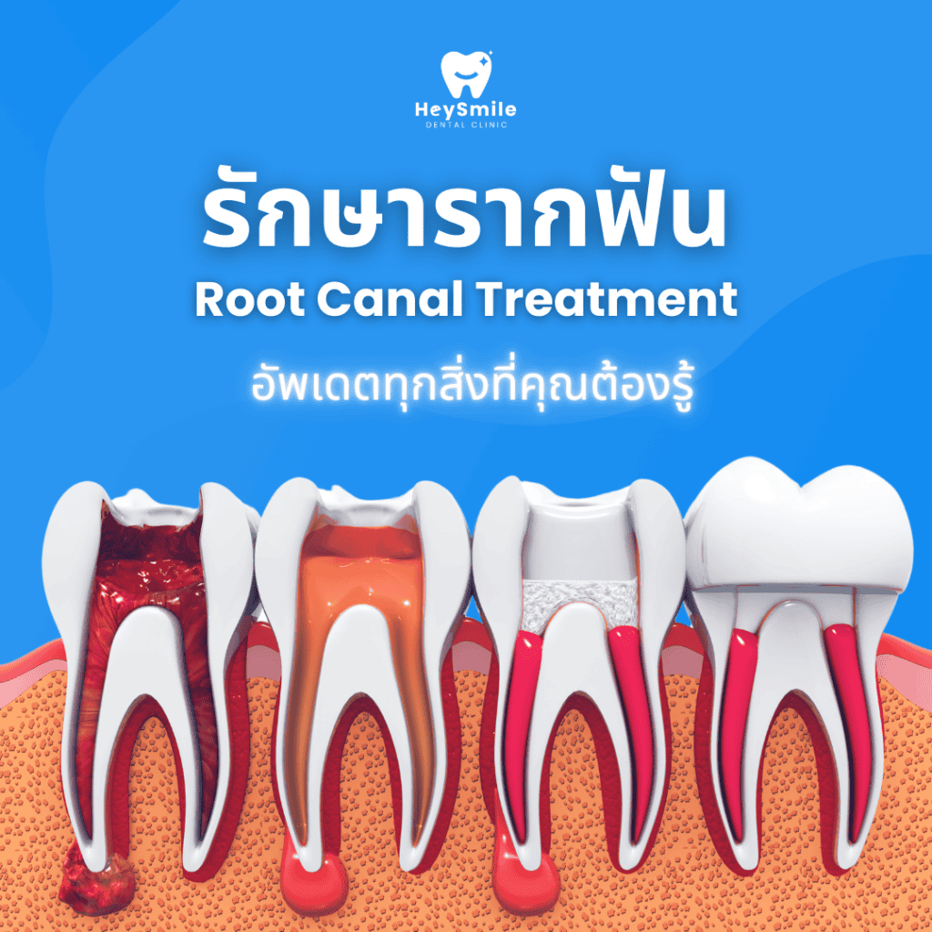 รักษารากฟัน Root canal treatment