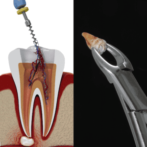 รักษารากฟันหรือถอนฟันดี