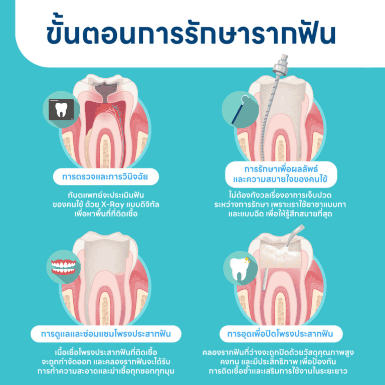 วิธีรักษารากฟัน