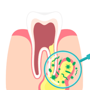 หนองปลายรากฟัน