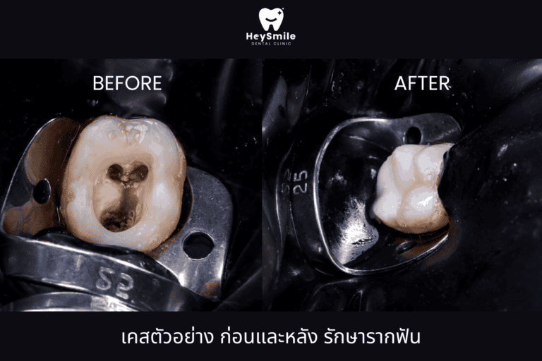 เคสตัวอย่าง ก่อนและหลัง รักษารากฟัน