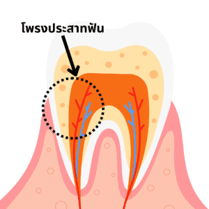 โพรงประสาทฟัน