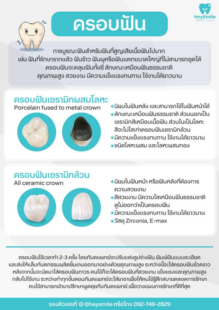 ขั้นตอนการทำครอบฟันจากเริ่มต้นถึงเสร็จสมบูรณ์ scaled