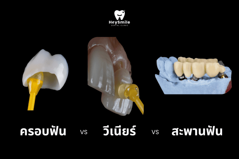 ครอบฟัน vs วีเนียร์ vs สะพานฟัน อะไรเหมาะกับคุณ