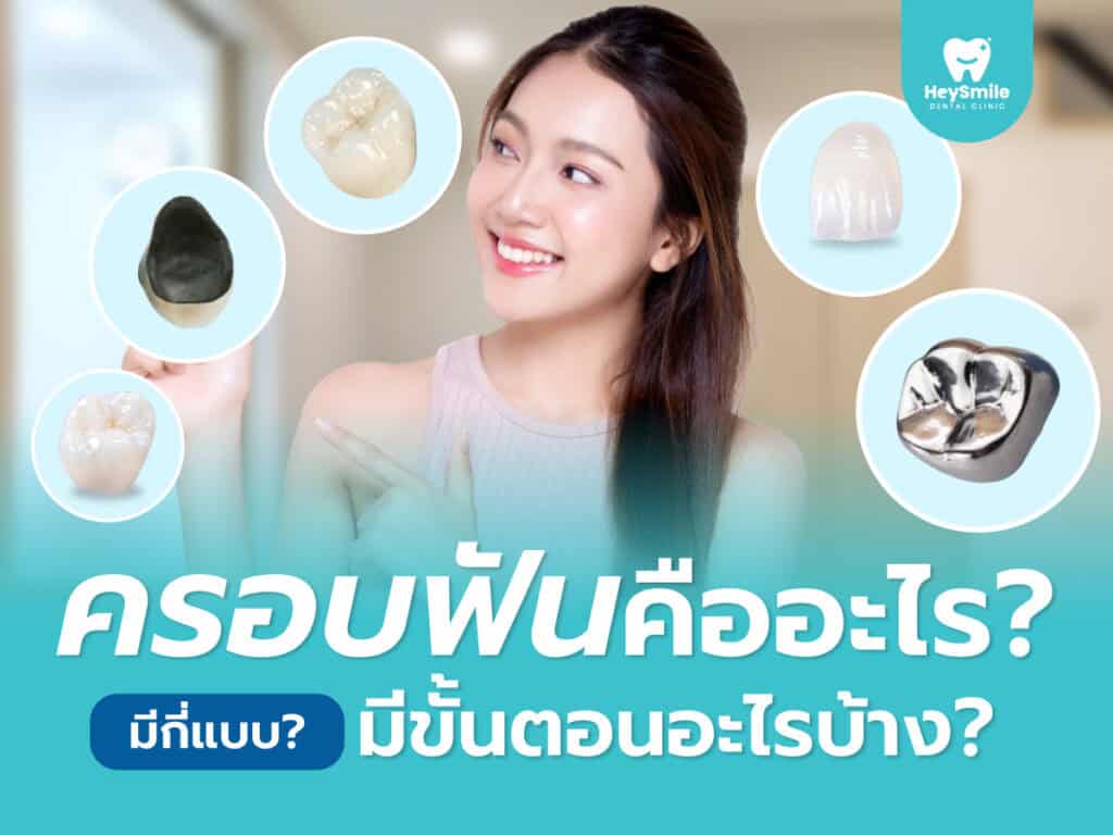 ครอบฟัน คืออะไร