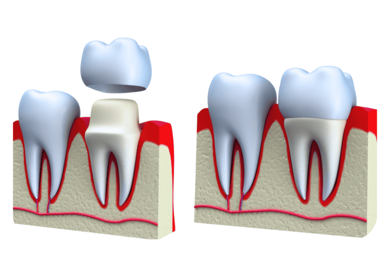 ครอบฟัน คืออะไร