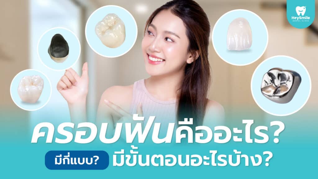 ครอบฟัน คืออะไร ครอบฟันมีกี่แบบ
