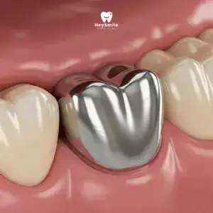 ครอบฟันเหล็กไร้สนิม Stainless Steel Crown