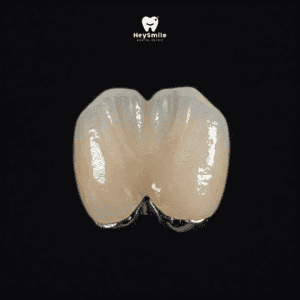 ครอบฟันโลหะเคลือบเซรามิก Porcelain Fused to Metal Crown
