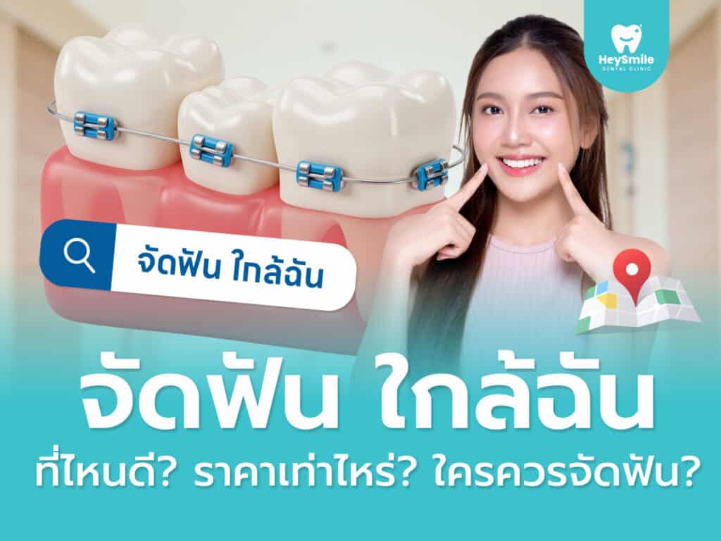 จัดฟัน ใกล้ฉัน ที่ไหนดี