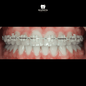 จัดฟันแบบเซรามิก Ceramic