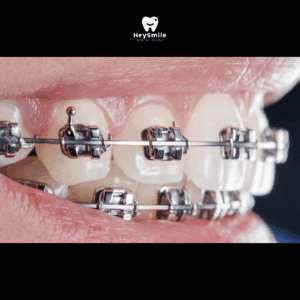 จัดฟันแบบโลหะ Metal