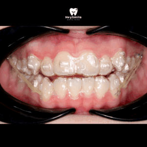 จัดฟันแบบใส