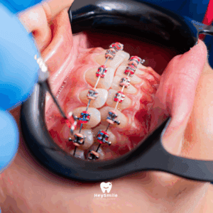 ดูแลตัวเองอย่างไร สำหรับคน จัดฟัน ให้ฟันสวย สุขภาพดีตลอดการรักษา