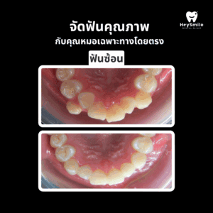 ฟันซ้อน 2