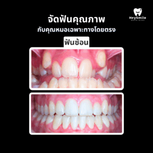 ฟันซ้อน