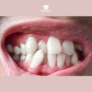 ฟันซ้อน ฟันเอียง หรือฟันบิด