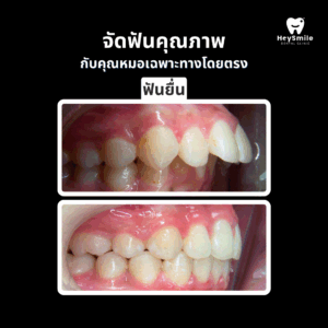 ฟันยื่น