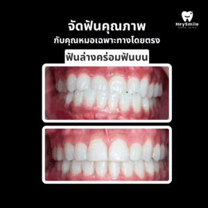 ฟันล่างคร่อมฟันบน
