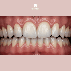 ฟันสบคร่อม Cross Bite