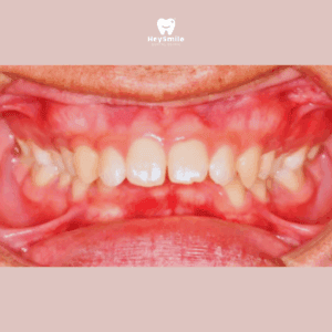 ฟันสบลึก Deep Bite 1