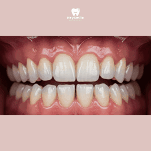 ฟันสบเปิด Open Bite หรือ ฟันไม่สบกัน