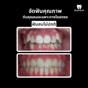 ฟันสบไม่ปกติ
