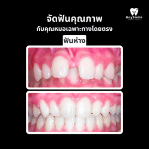 ฟันห่าง 1