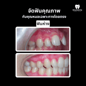 ฟันห่าง 2