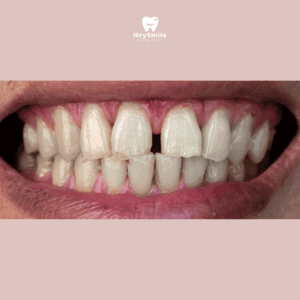 ฟันห่าง