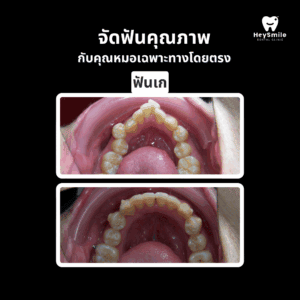 ฟันเก