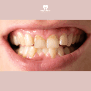 ฟันเบี้ยว