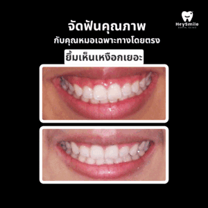 ยิ้มเห็นเหงือกเยอะ