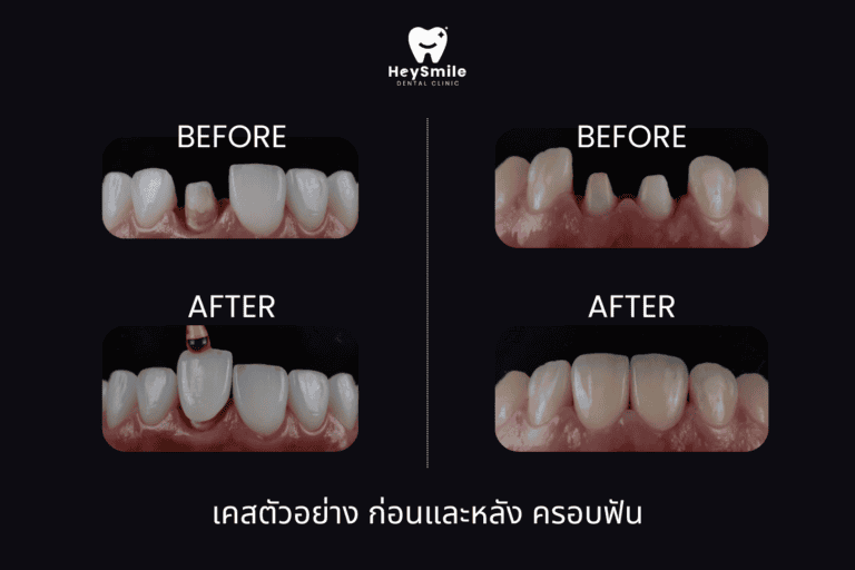 เคสตัวอย่างทำครอบฟัน