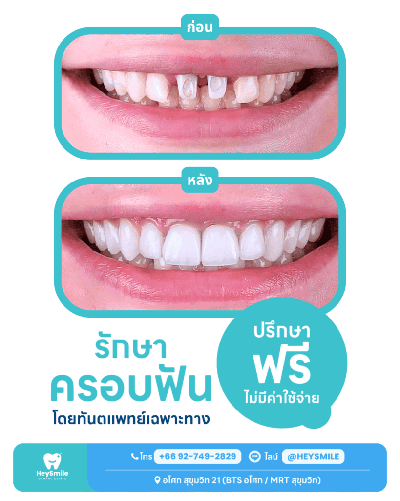 ใครบ้างที่ควรพิจารณาทำ ครอบฟัน 1