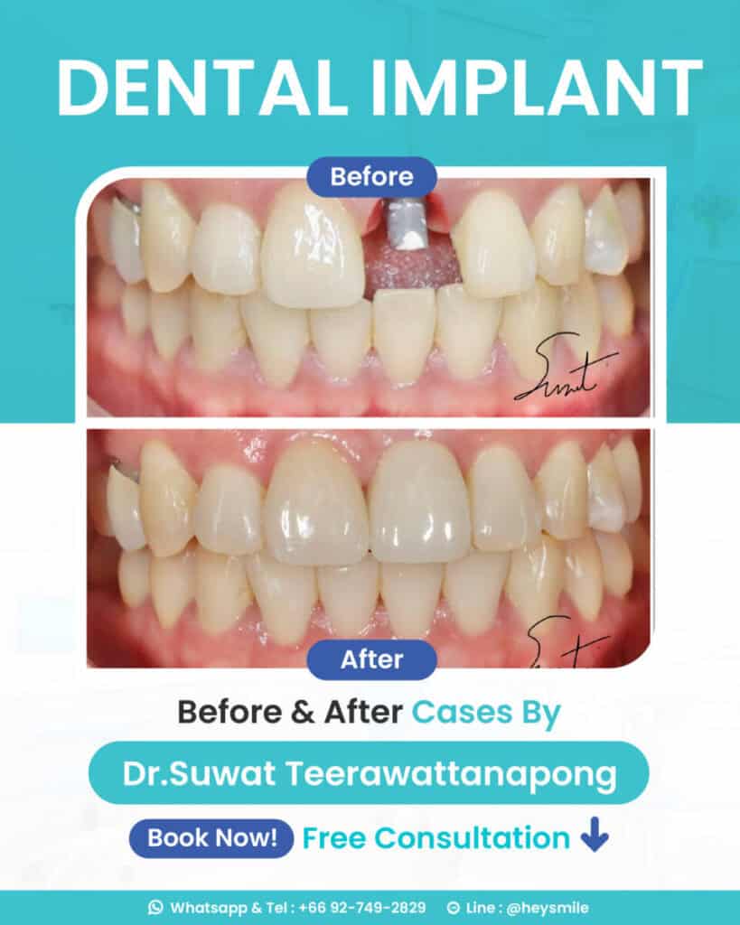นัดปรึกษาฟรี! กับ ทพ. สุวัฒน์ ตีระวัฒนพงษ์
