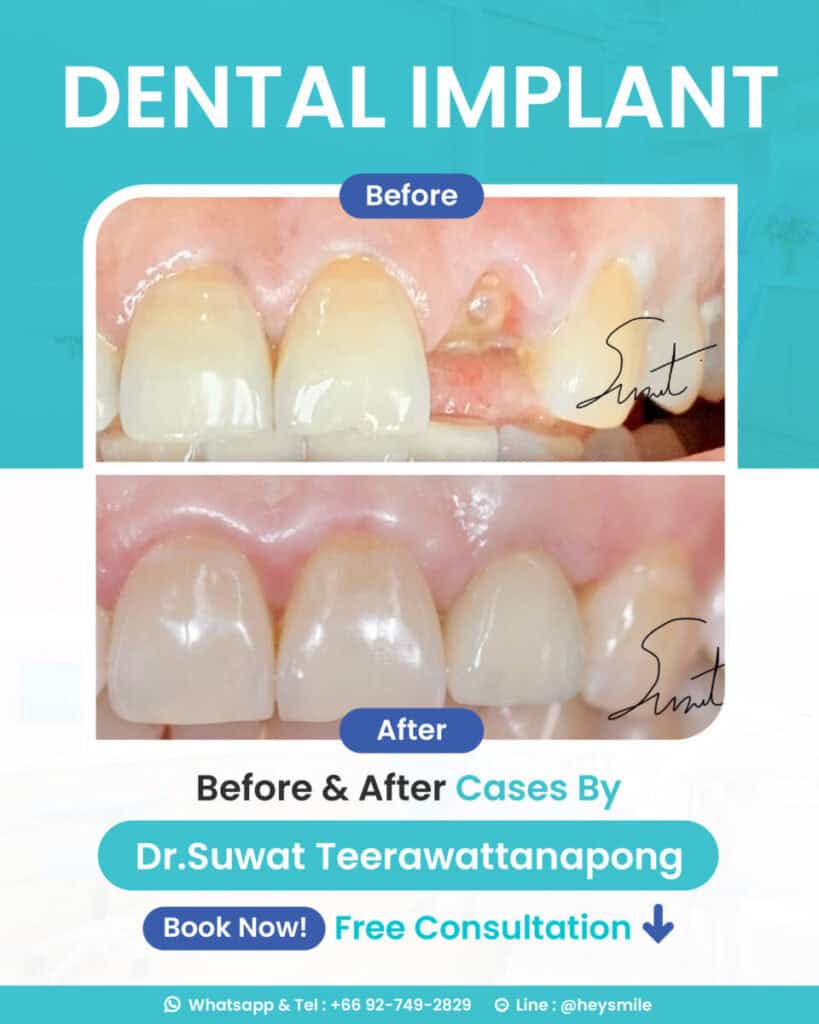 นัดปรึกษาฟรี! กับ ทพ. สุวัฒน์ ตีระวัฒนพงษ์