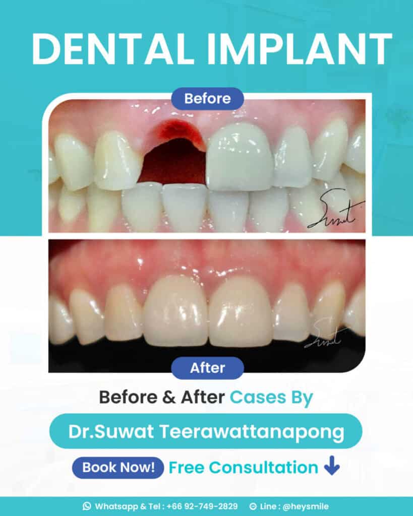 นัดปรึกษาฟรี! กับ ทพ. สุวัฒน์ ตีระวัฒนพงษ์