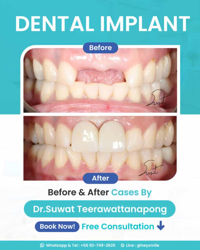 นัดปรึกษาฟรี! กับ ทพ. สุวัฒน์ ตีระวัฒนพงษ์
